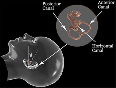 Diagnostic and Therapeutic Maneuvers for Anterior Canal BPPV Canalithiasis: Three-Dimensional Simulations